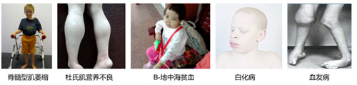 做试管婴儿怎样预防胎儿染色体异常？