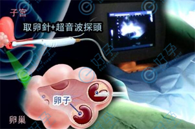 试管促排取卵女性体内的激素水平如何变化？