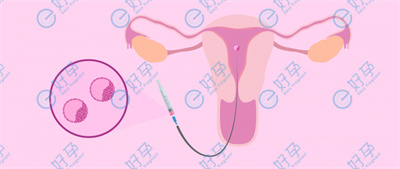 做试管婴儿，移植两个与一个的成功率谁更高？