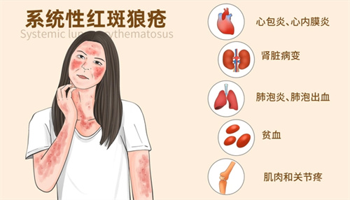 红斑狼疮是否会影响卵子质量？该如何做试管婴儿？