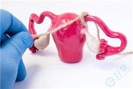 输卵管粘连导致的不孕，适合做试管婴儿吗？