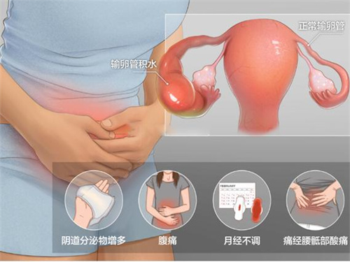 试管科普：输卵管积水为什么成了胚胎移植的“拦路虎”