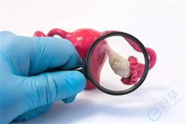 巧克力囊肿对自然生育和做试管婴儿的影响如何?