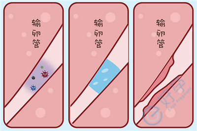 患有输卵管疾病的女性，做试管婴儿如何实现健康生育？