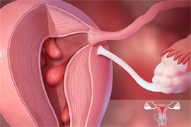 当女性出现子宫内膜息肉时，该怎么做试管婴儿？
