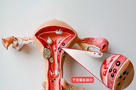 子宫腺肌症会对试管产生哪些影响？如何保障试管成功率？
