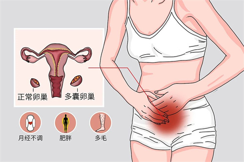 患有多囊卵巢的女性，做试管如何实现好孕？