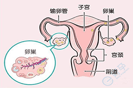 多囊卵巢综合症去美国做试管婴儿，能成功吗？