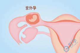宫外孕是怎么引起的?试管婴儿技术如何降低宫外孕的发生率？