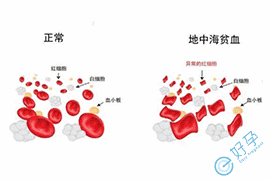 地中海贫血可以做试管婴儿吗？试管费用是多少？