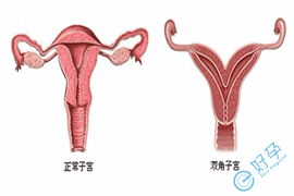 e好孕：双角子宫流产率高能做试管婴儿吗？