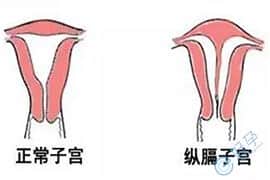 纵膈子宫做试管可以吗？具体方案是什么？