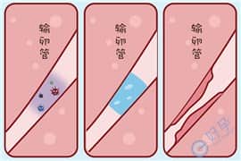 输卵管积水的女性做试管婴儿，有什么样的方案？