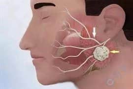 腮腺炎真的会导致男性不育吗，试管技术能否成功助孕？