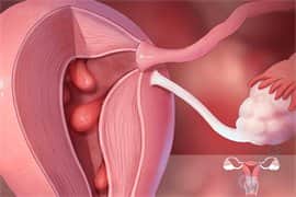 子宫息肉的3种危害，如何决定能不能做试管？