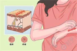 皮肤病会不会遗传给孩子，可以做试管婴儿吗?