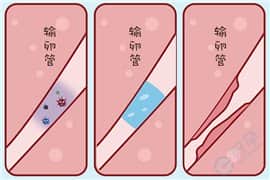 输卵管积水可以去泰国做试管婴儿吗？